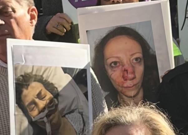 E-bike violence victims showed their battered faces suffered after accidents at Sept. 27 City Hall rally.